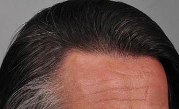 Hair transplantation surgery before and after photos