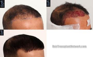 Hair transplantation surgery before and after photos