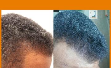 Hair transplantation surgery before and after photos