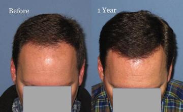 Before and after hair transplantation result photographs