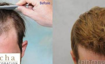 Hair transplantation surgery before and after images