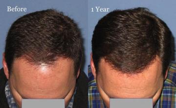 Top view - Before and after surgical hair replacement