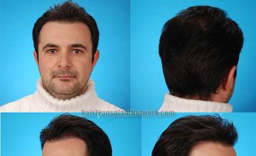 Hair restoration procedure before and after result photographs