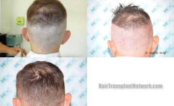 Hair transplantation surgery before and after pictures