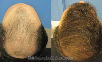 Crown / Top view before and after hair replacement procedure