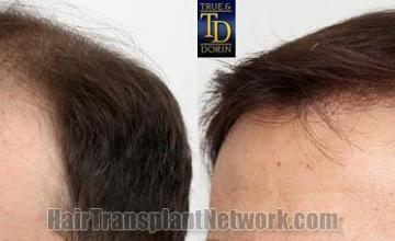 Hair transplantation surgery before and after pictures