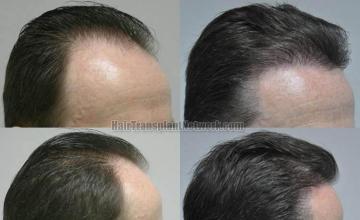 Hair transplantation surgery before and after images