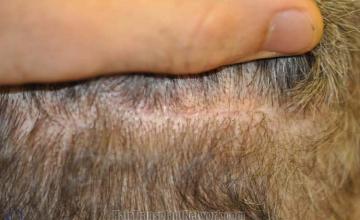 Residual Scar after hair transplantation photo