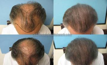 Top view - Before and after surgical hair replacement