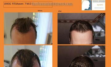 Top view - Before and after surgical hair replacement