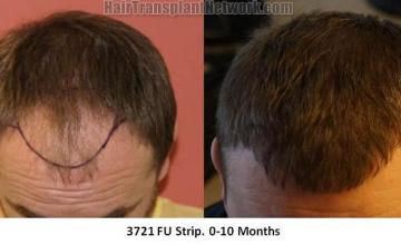 Hair restoration procedure before and after results