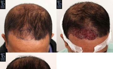 Hair restoration procedure before and after results