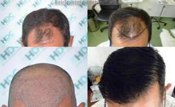 Hair transplantation surgery before and after images