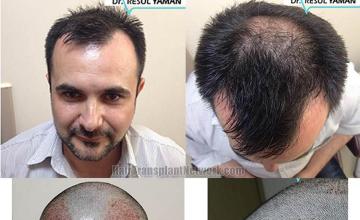 Hair restoration surgery after photos