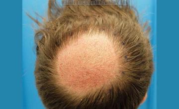 Hair restoration procedure before and after result images