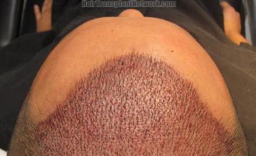 Hair transplantation surgery before and after photos