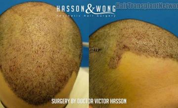 Hair transplant surgery before and after images