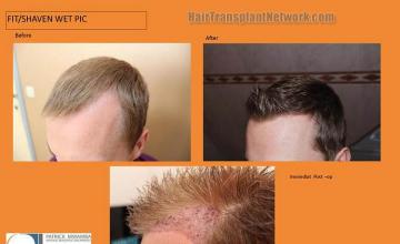 Hair transplantation surgery before and after photos