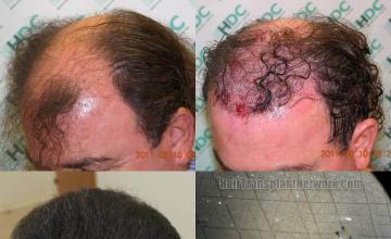 Hair transplantation surgery before and after photos