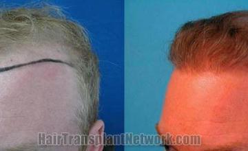 Hair restoration procedure before and after results