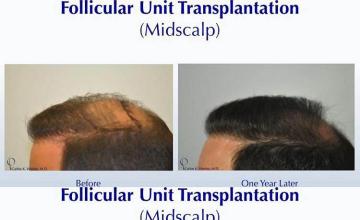 Hair transplantation surgery before and after pictures