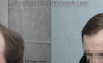 Hair transplantation surgery before and after photos