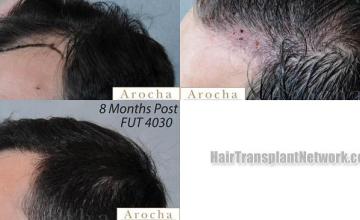 Hair transplantation surgery before and after images