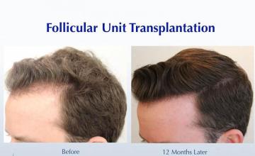 Hair transplantation surgery before and after photos