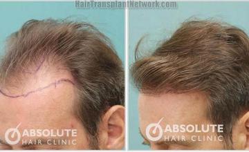 Hair restoration procedure before and after pictures