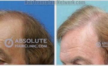 Hair restoration procedure before and after pictures