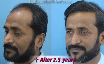 Hair restoration procedure results