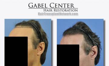 Hair restoration procedure before and after pictures