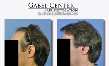 Hair transplantation surgery before and after images