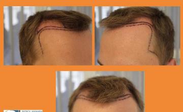 Hair transplantation surgery before and after images