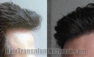 Hair transplantation surgery after images