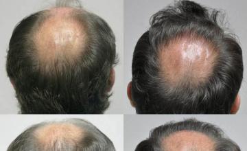 Surgical hair transplantation result photographs