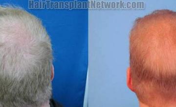 Hair transplantation surgery before and after images