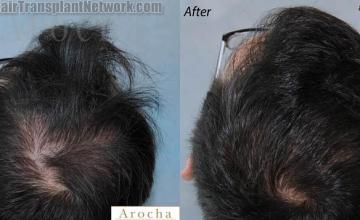 Hair transplantation surgery before and after pictures