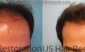 Front view - Before and after