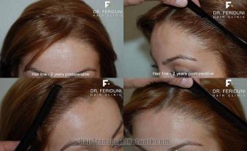 Hairline results from 1982 graft hair female hair restoration