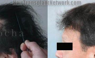 Left View hair transplant correction procedure