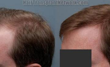 Hair restoration procedure results