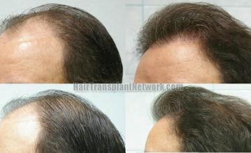 Hair restoration procedure results