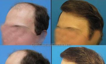 Hair transplantation surgery before and after images