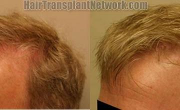 Hair transplantation surgery before and after images