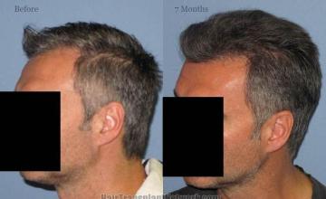 Hair transplantation surgery before and after pictures