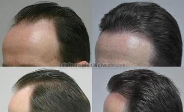 Hair transplantation surgery before and after pictures