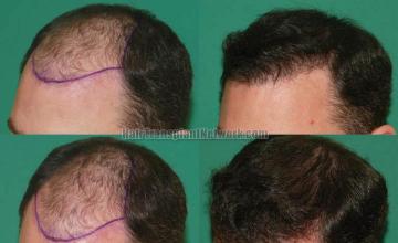 Hair restoration procedure before and after pictures