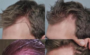 Hair transplantation surgery before and after pictures