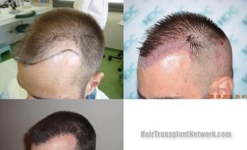 Hair transplantation surgery before and after pictures